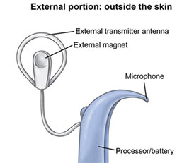 Cochlear Implant in India - External Portion