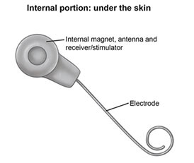 cochlear Implant