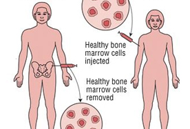 Allogenic Bone Marrow Transplant