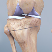 Knee-Osteotomy