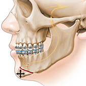 chin osteotomy