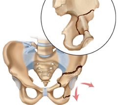 hip osteotomy surgery