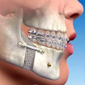 jaw osteotomy