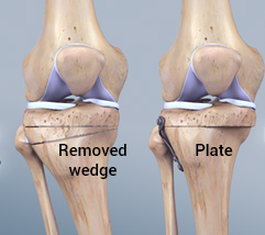 knee osteotomy surgery