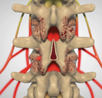 Laminectomy surgery in India