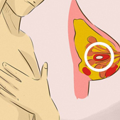 Lump in breast, not always breast cancer