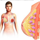 Fibrocystic breasts, not necessarily breast cancer