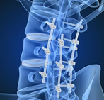 Spinal fusion