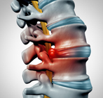 Spinal stenosis treatment in India