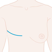 Mastectomy for breast cancer treatment