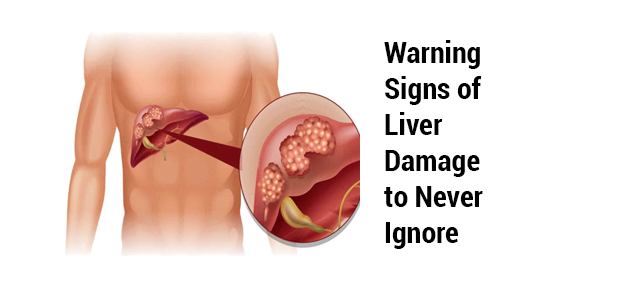 Cirrhosis of the Liver: Signs & Symptoms, Causes, Stages