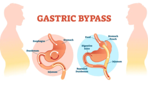 bariatric surgery gastric bypass