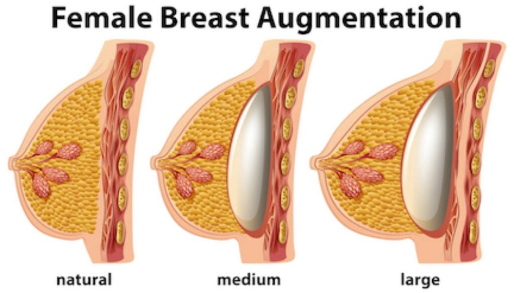 Breast Augmentation In India