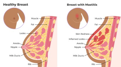 Mastitis Breasts After Pregnancy