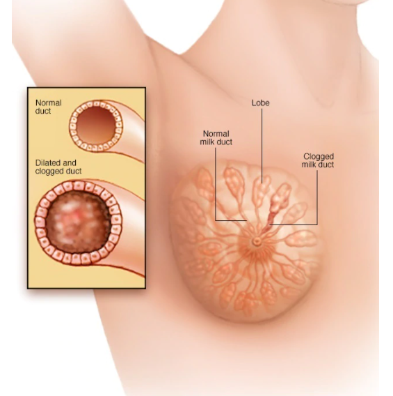 Blocked Milk Ducts