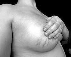 Stretch Marks on Breasts after pregnancy