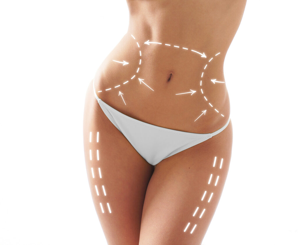 Tummy Tuck Surgery