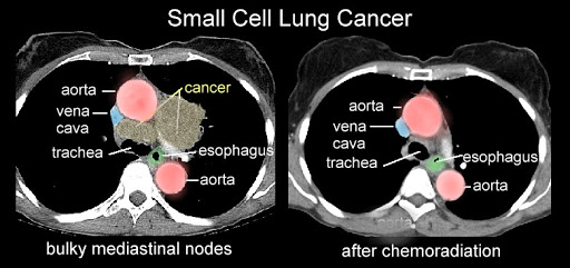 CT Scan Lung cancer