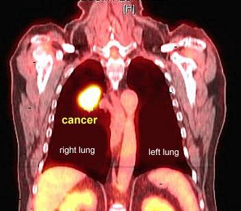 PET CT Scan lung cancer