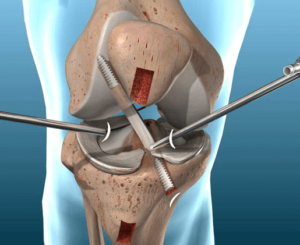 acl reconstruction surgery in india, cost of acl surgery in india, best acl surgeon in india