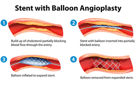 best hospital for angioplasty in india