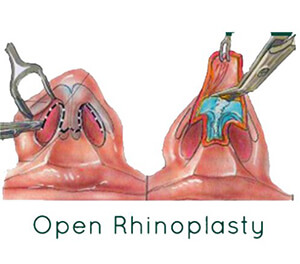 rhinoplasty in India | MedicoExperts