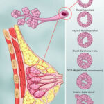 Infiltrating Ductal Cancer