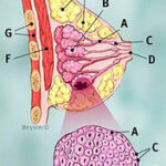 Infiltrating Lobular Cancer 