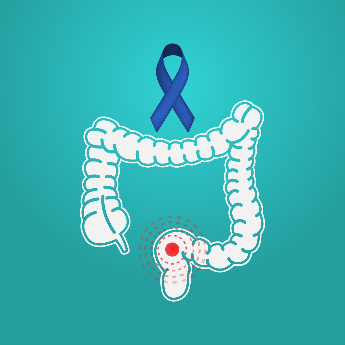 what are the causes of colon cancer, colon cancer treatment in india