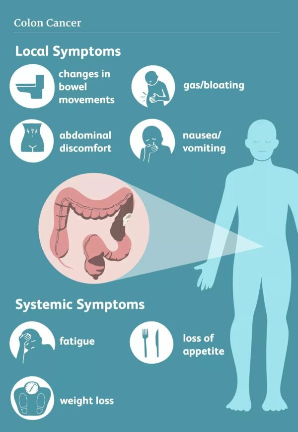 Advanced Colon Cancer Treatment 