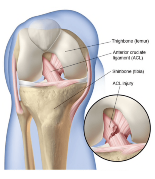 acl reconstruction surgery cost, best acl surgery in india