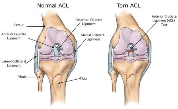 best hospital for ligament surgery in india, success rate of acl surgery in india