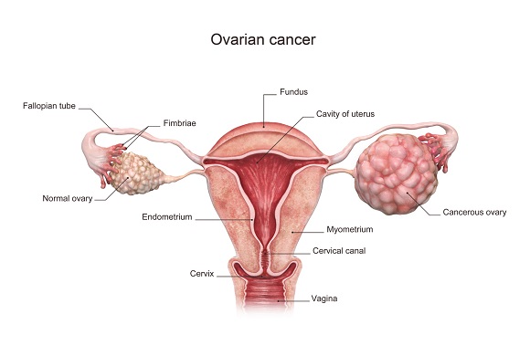 what is ovarian cancer, ovarian cancer treatment in india