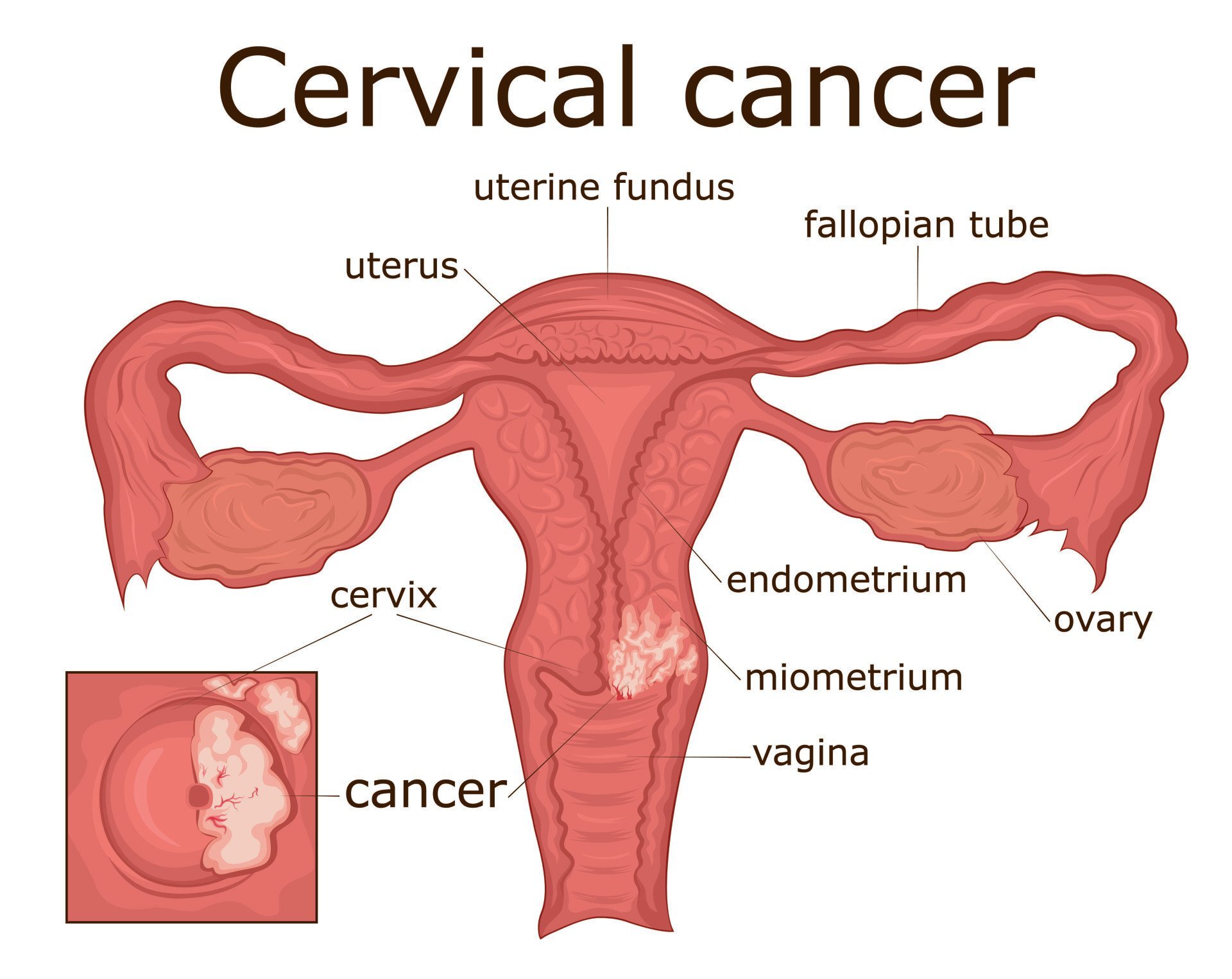 cervical cancer treatment in india, best doctor for cervical cancer