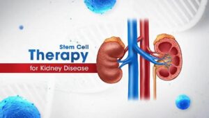 stem cell therapy for kidney disease,  stem cells help in treating chronic kidney disease