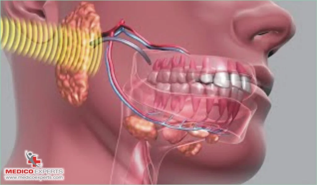 Internal Radiotherapy for Mouth Cancer, Internal Radiotherapy