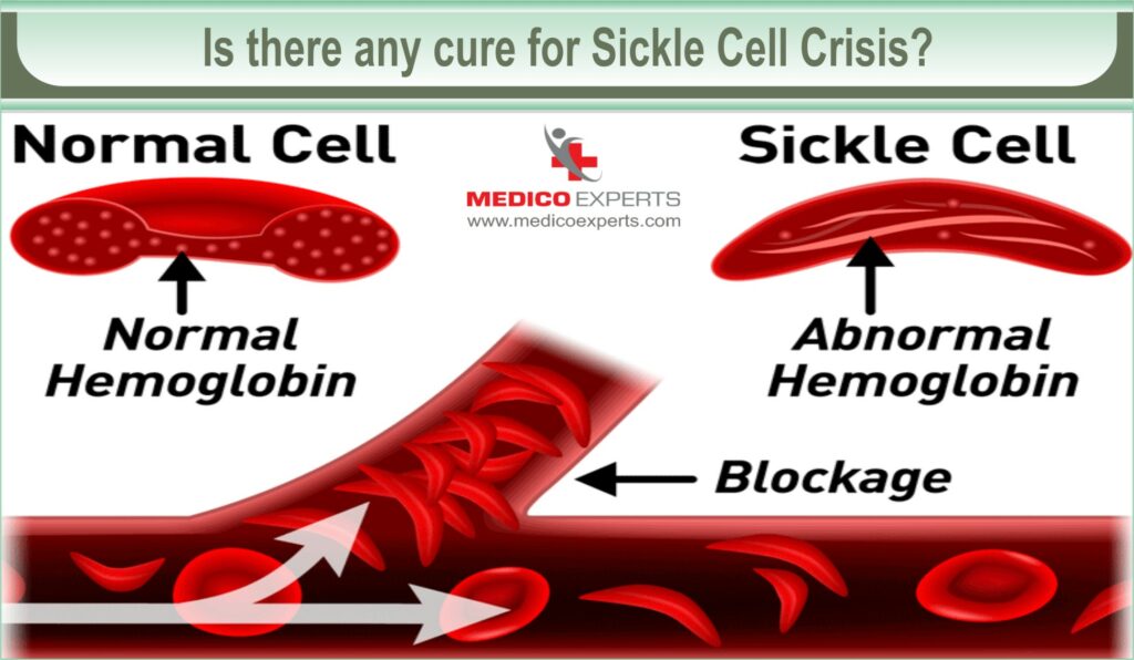 Avoid sickle cell crisis with bone marrow transplant