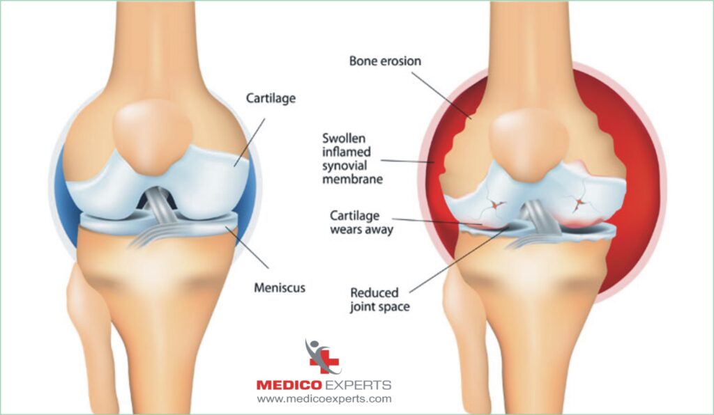 Stem cell therapy for knee arthritis treatment

non surgical knee arthritis treatment
stem cell for knee arthritis

Can knee arthritis heal without surgery?