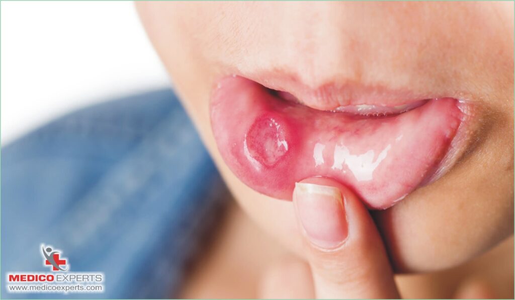 What are the symptoms of mouth cancer?, is mouth cancer curable without surgery