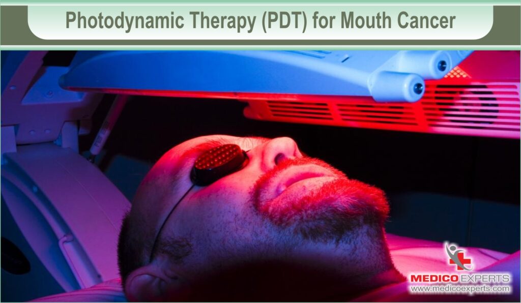 6-options-for-mouth-cancer-treatment-without-surgery