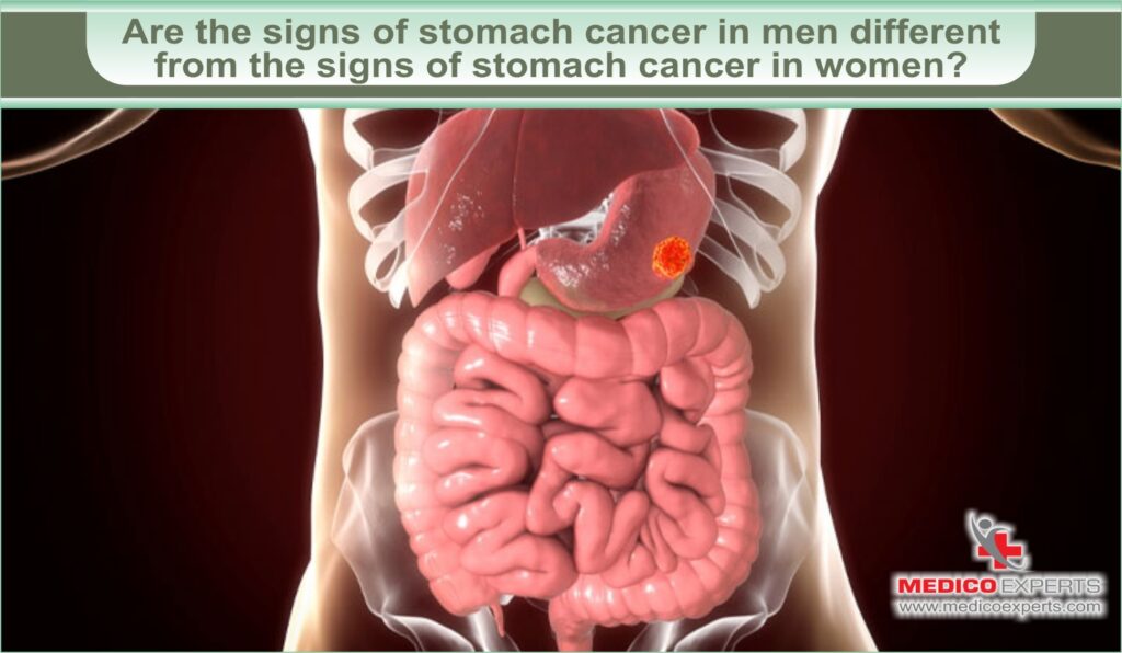 is stomach cancer curable in india, sign of stomach cancer