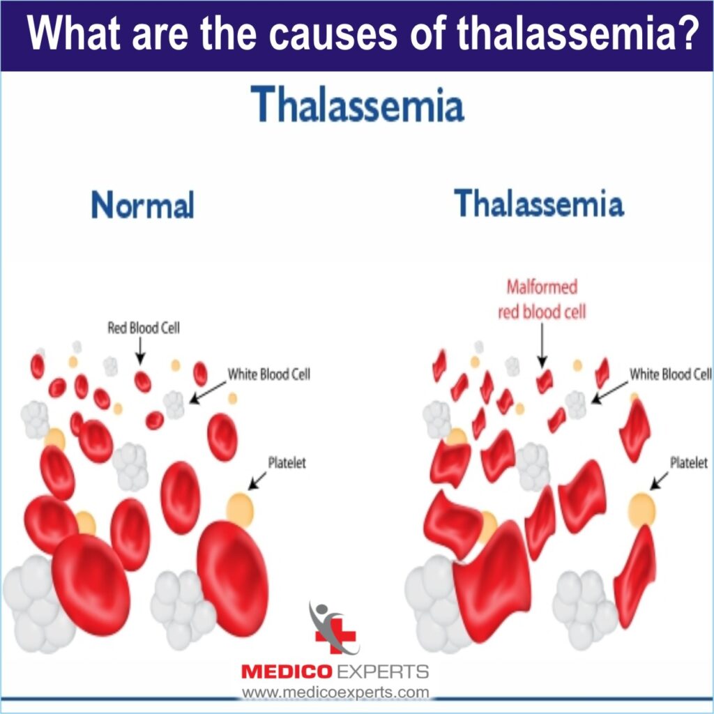 Thalassemia treatment in India without blood transfusion