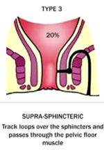 Suprasphincteric (20%)