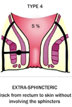 Extrasphincteric (5%)