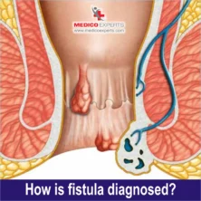 how fistula is diagnosed?