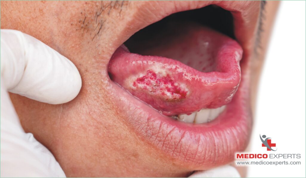 Diagnosis of Oral Cancer, is oral cancer curable if caught early