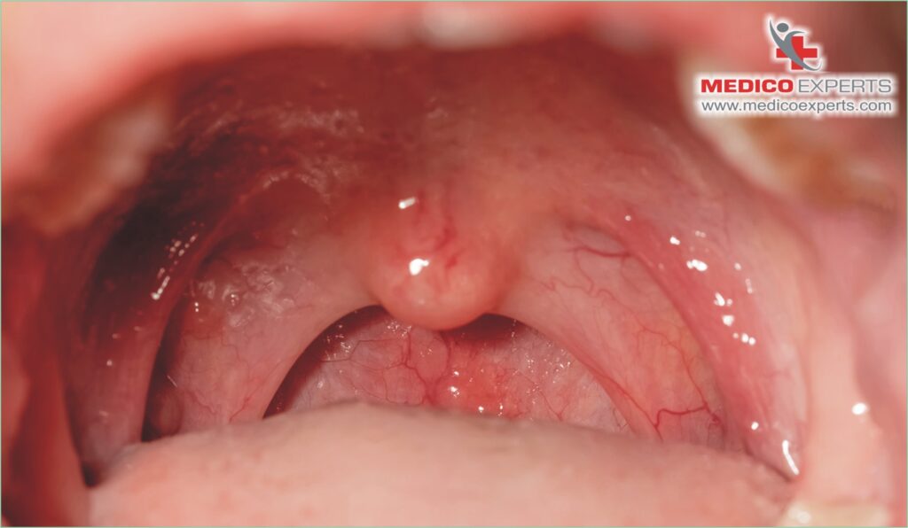 How Long Does Oral Cancer Take to Spread?, How risky is mouth cancer?