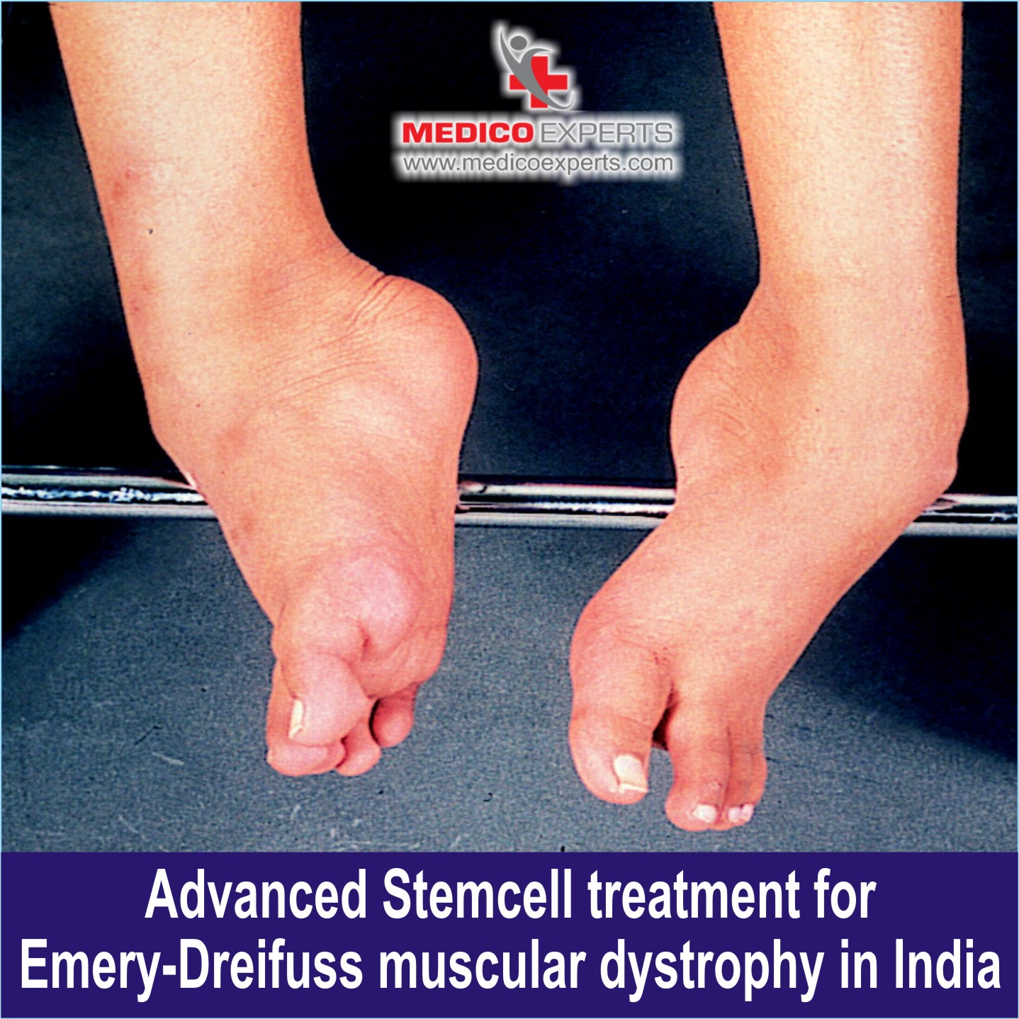 Advanced Stem cell treatment for Emery Dreifuss Muscular Dystrophy in India