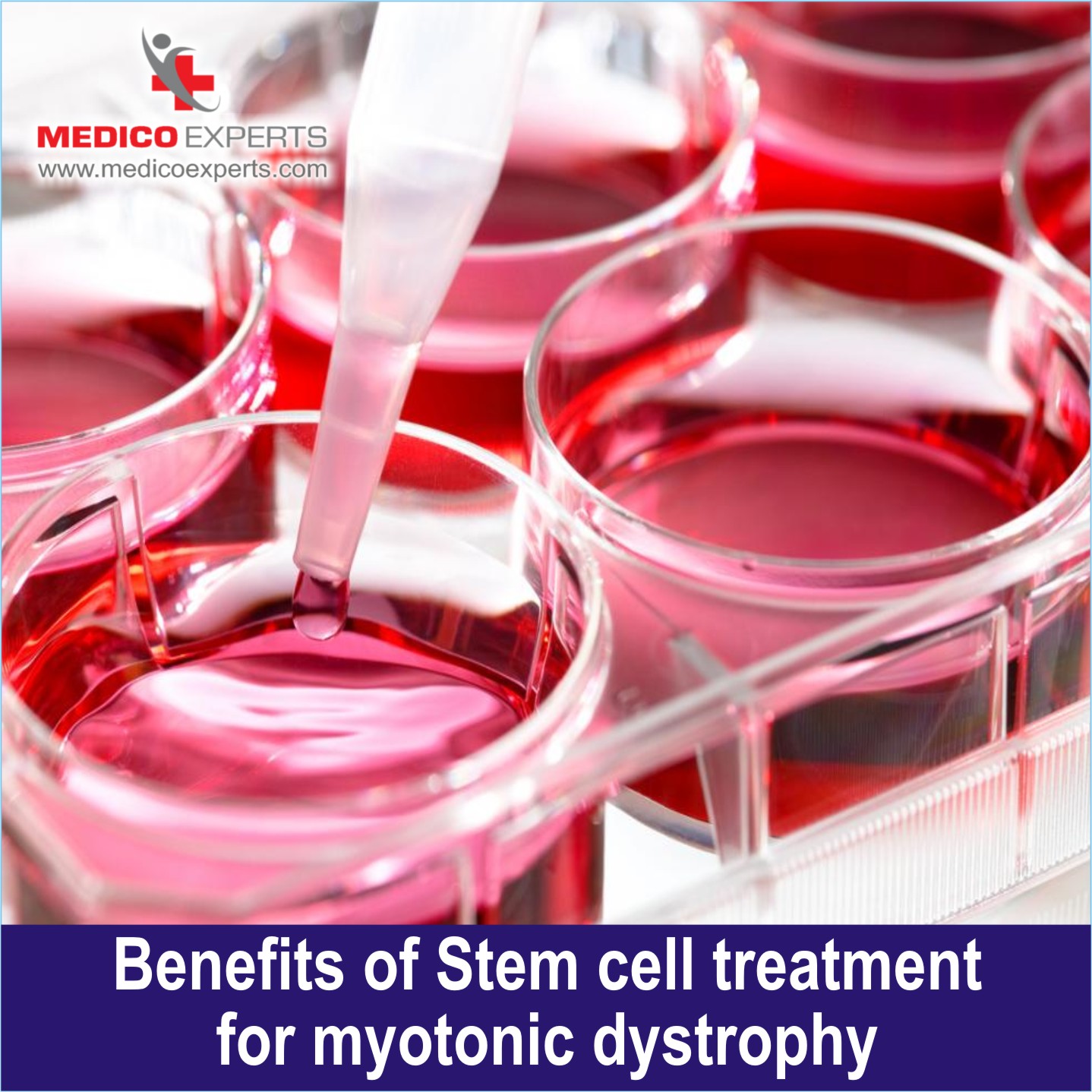 Benefits of stem cell therapy for Myotonic Dystrophy Treatment