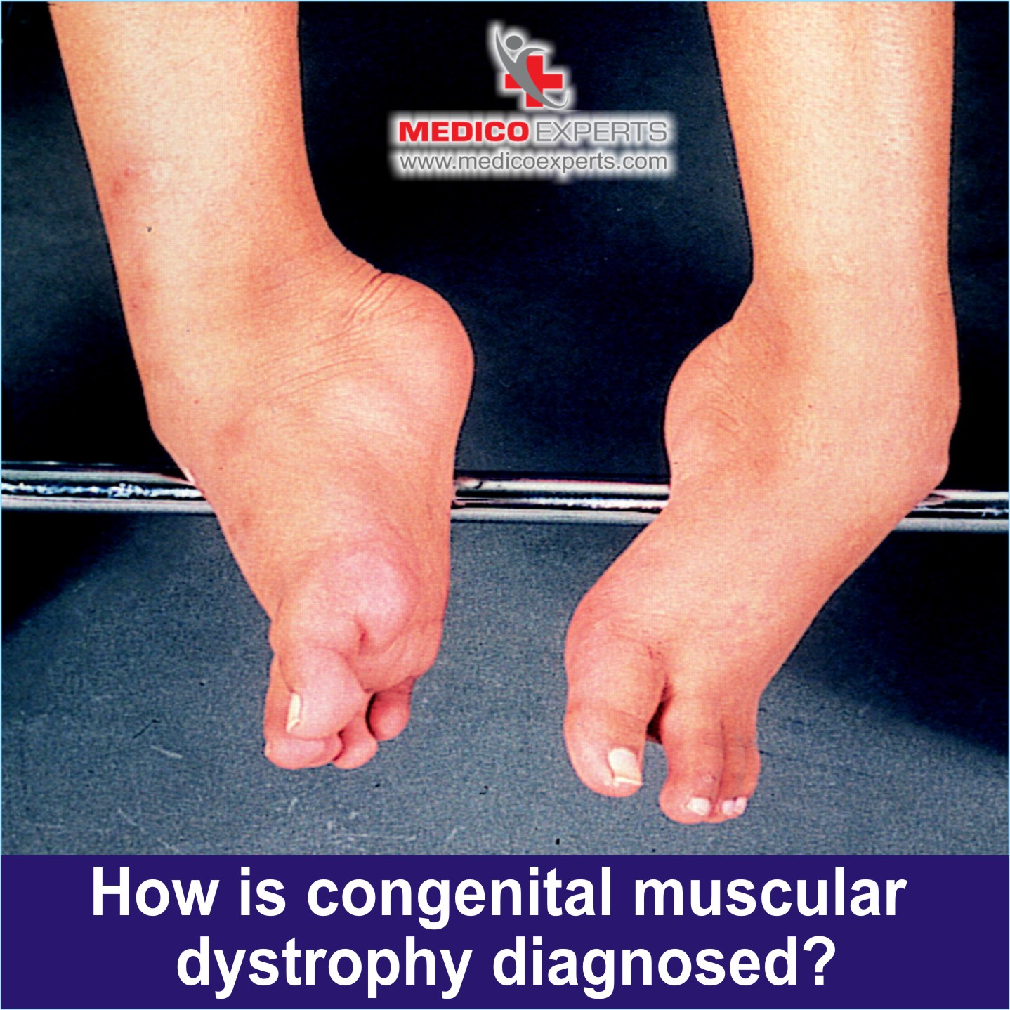 Congenital Muscular Dystrophy Diagnosed Test